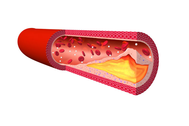 生活習慣病のイメージ写真